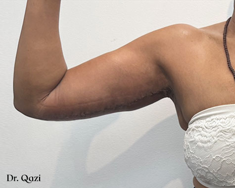 armlift after picture